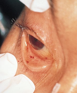 التهاب الشغاف العدوائي (أعراض عينية)
