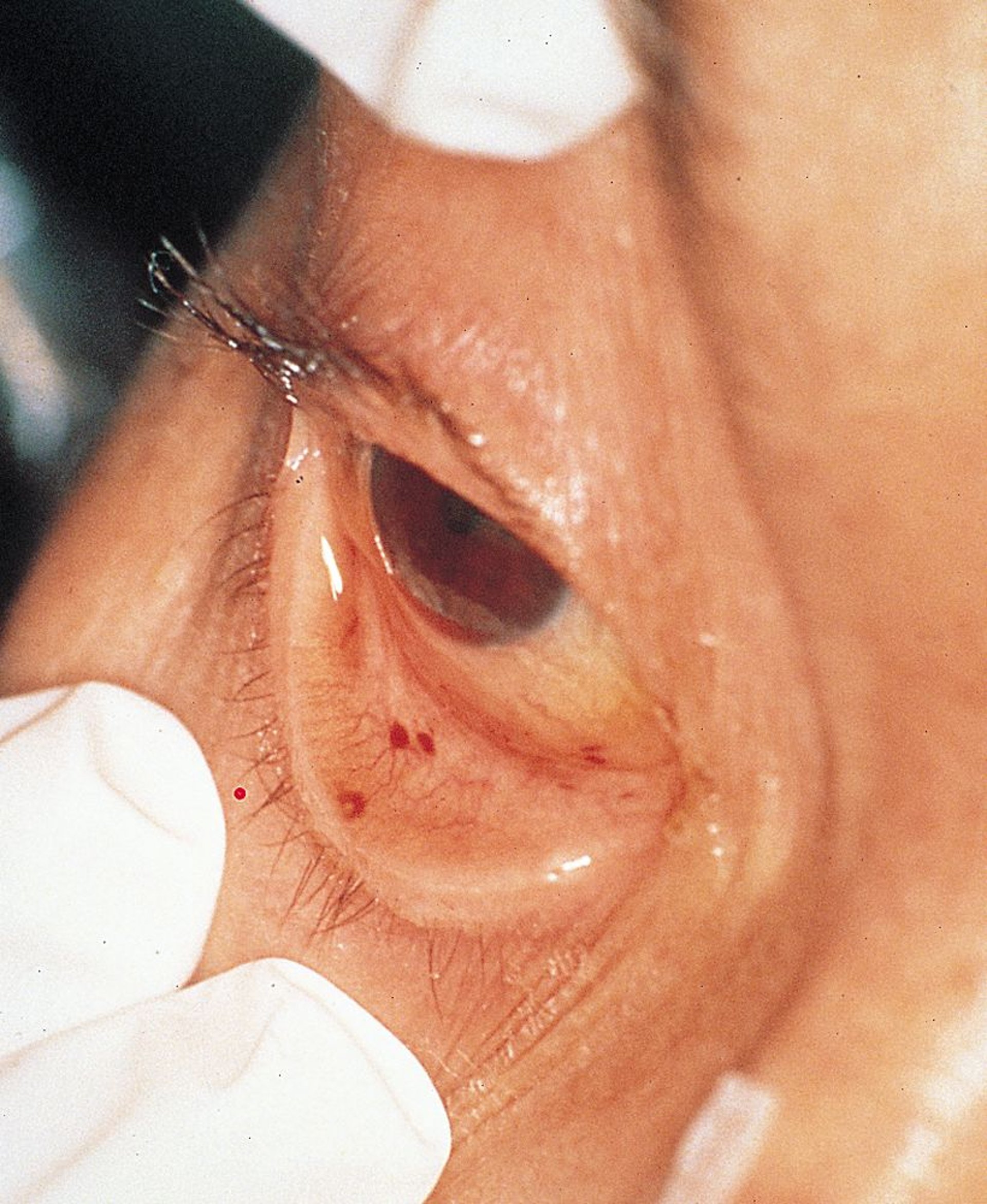 Infektiöse Herzinnenhautentzündung (Auge)