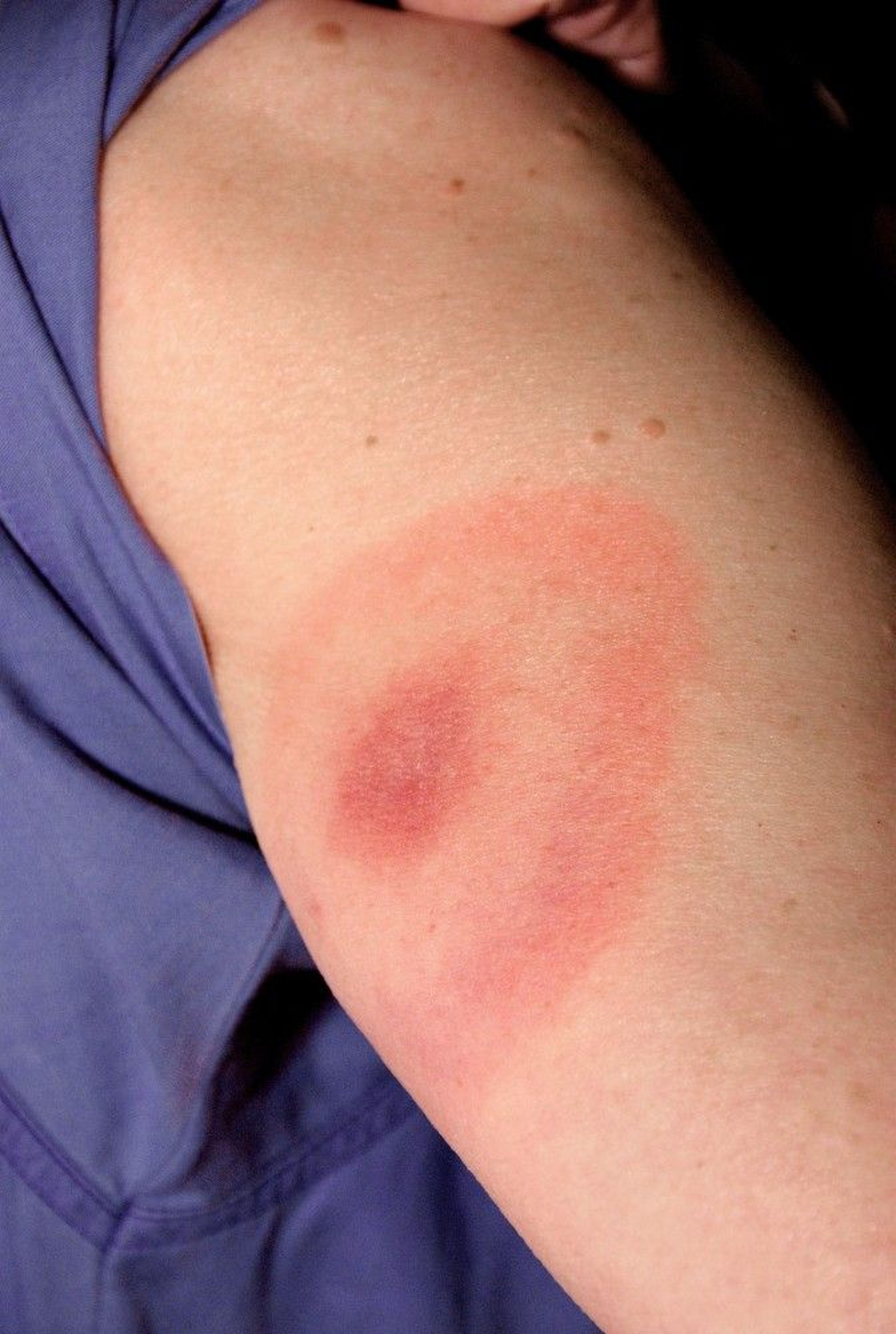 The Bull's Eye Rash of Lyme Disease (Erythema Migrans)