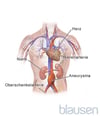Bauchaortenaneurysma