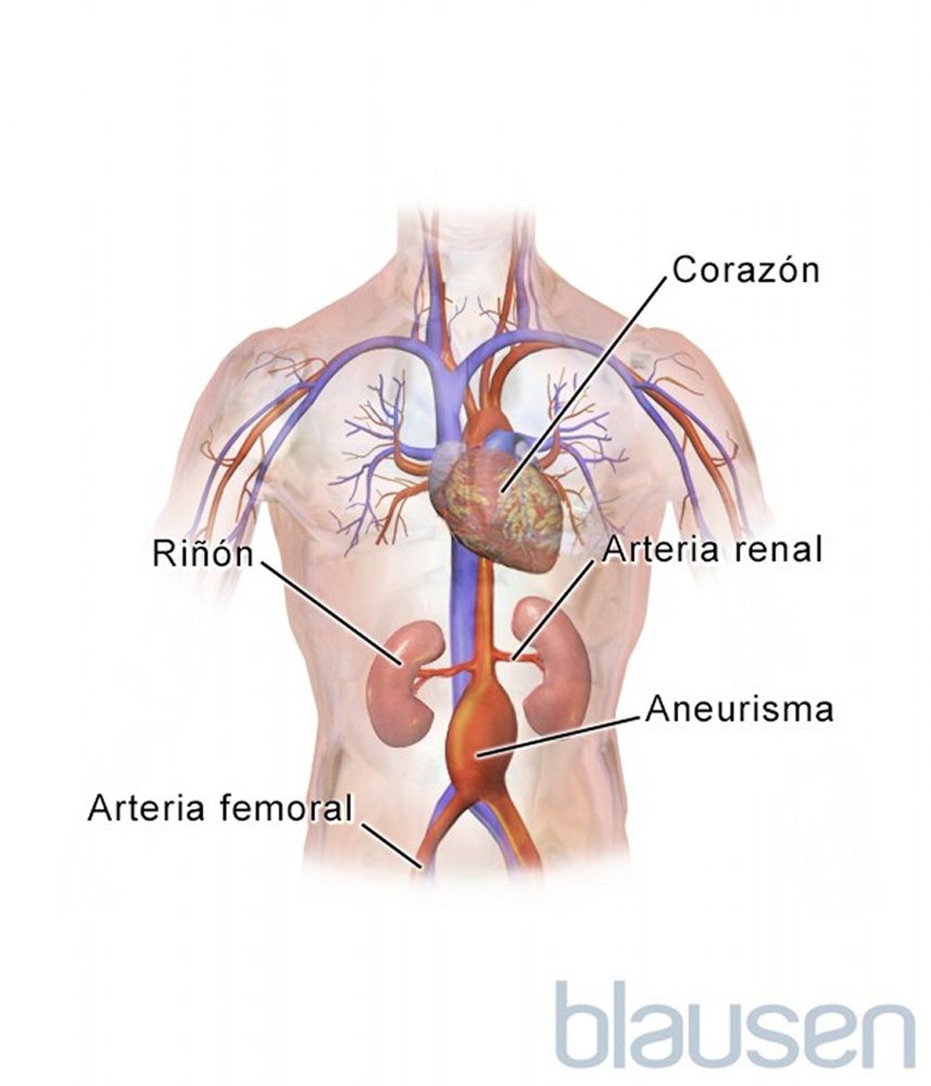 Aneurisma aórtico abdominal