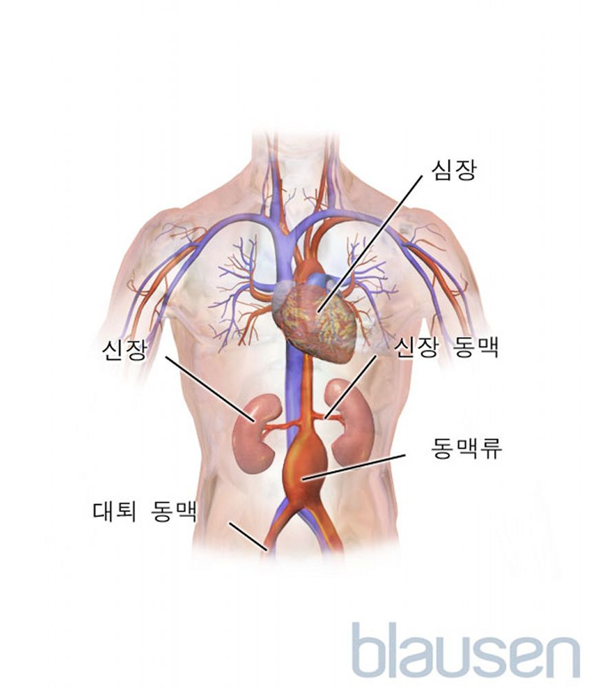 복부 대동맥류