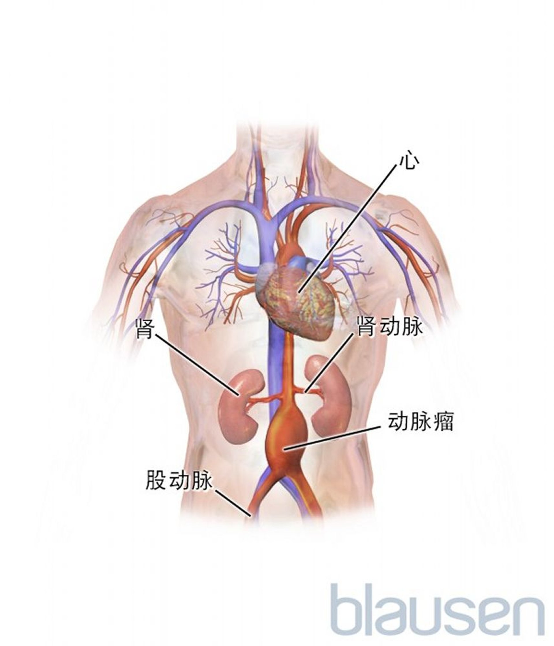 腹主动脉瘤