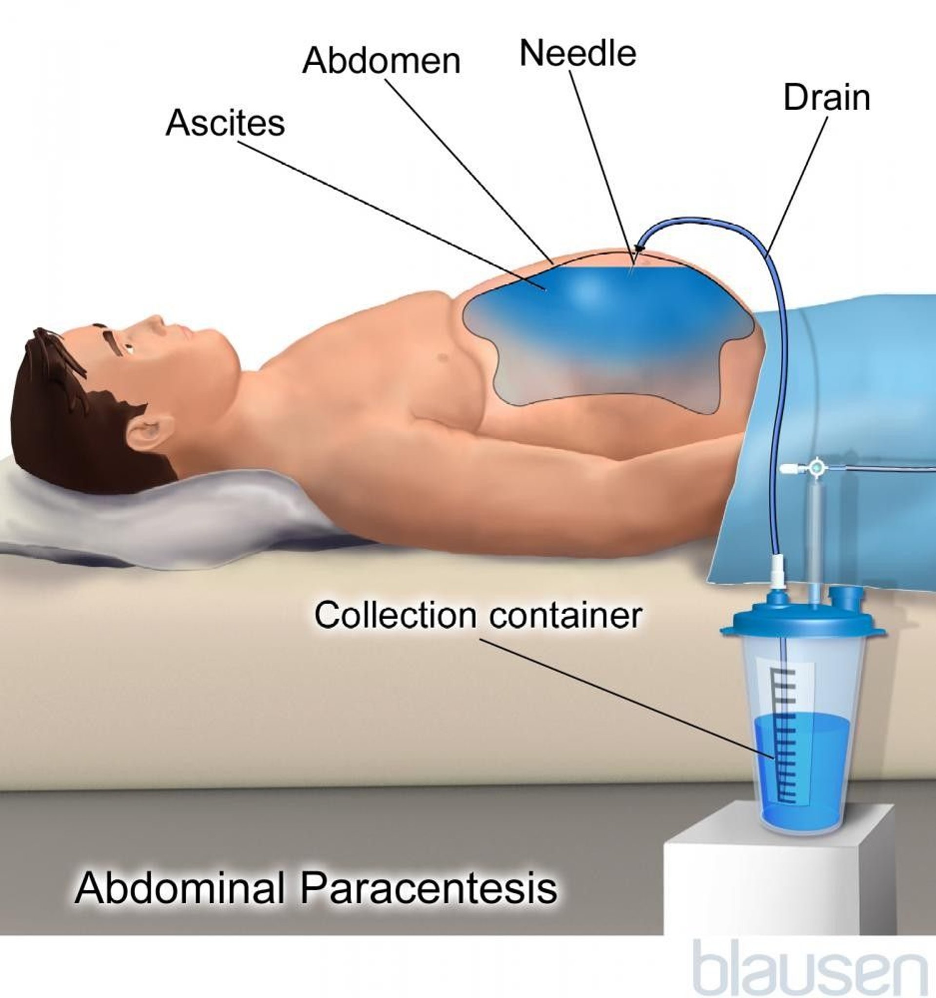 Abdominal Paracentesis