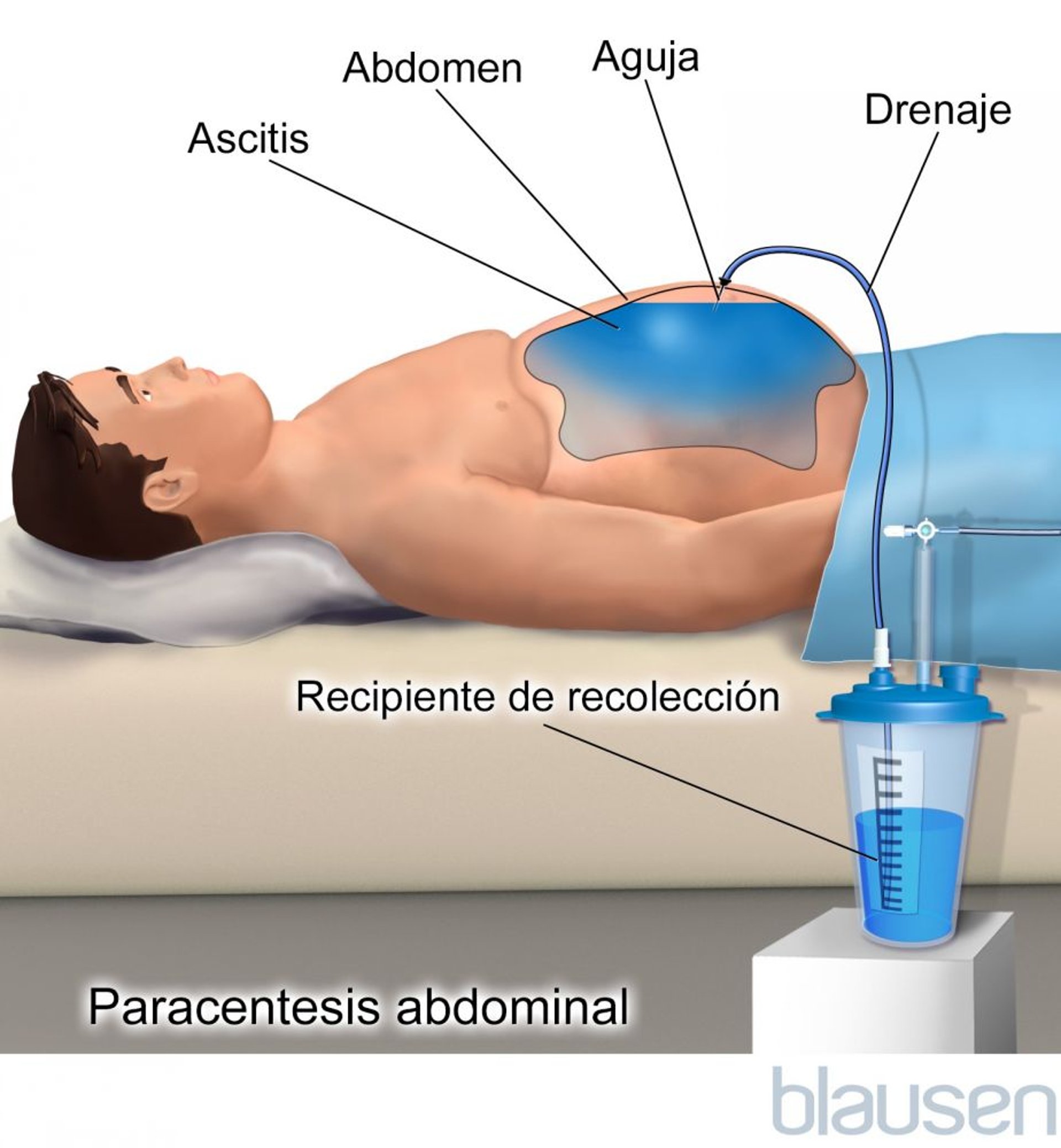 Paracentesis abdominal