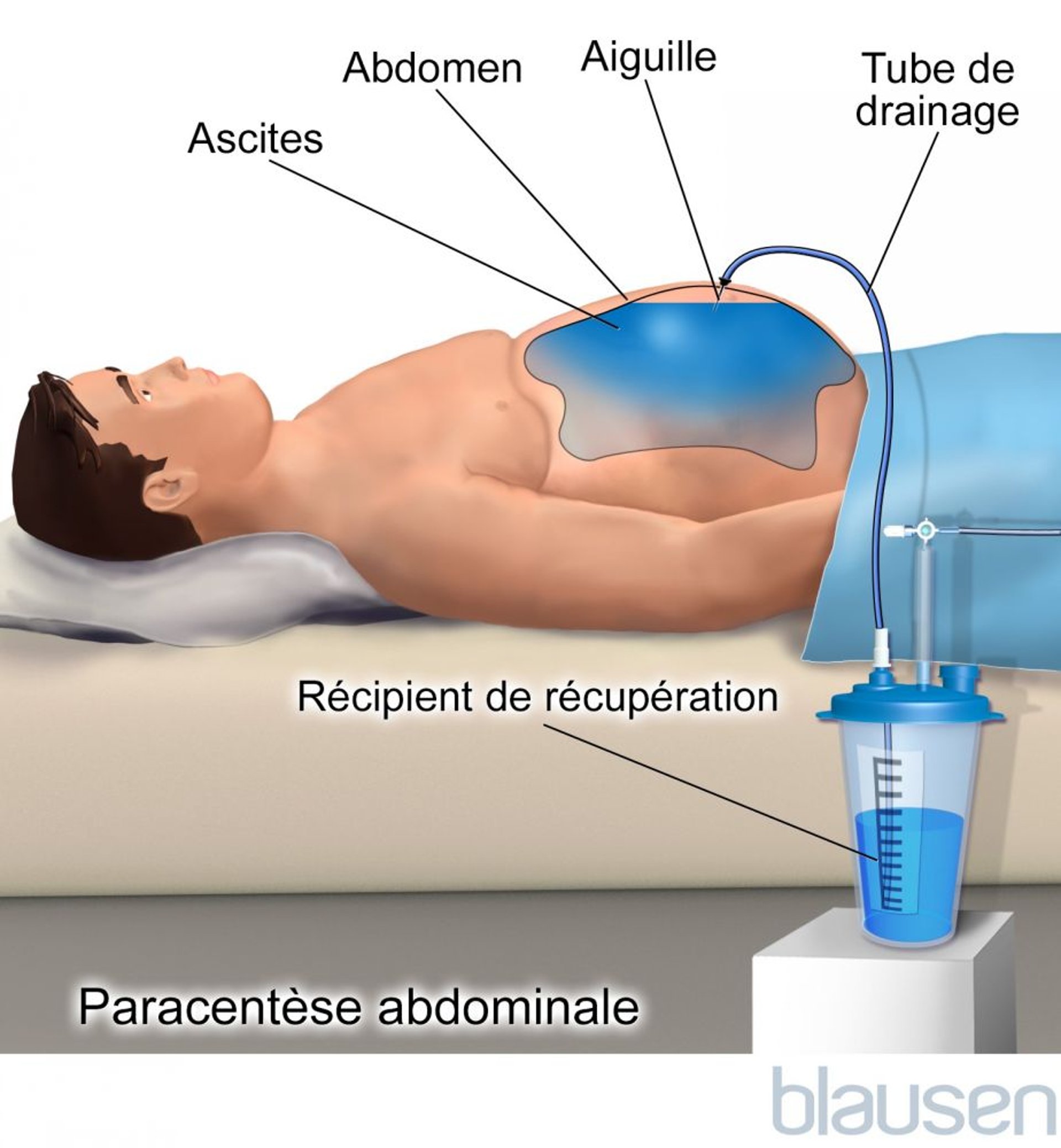 Paracentèse abdominale