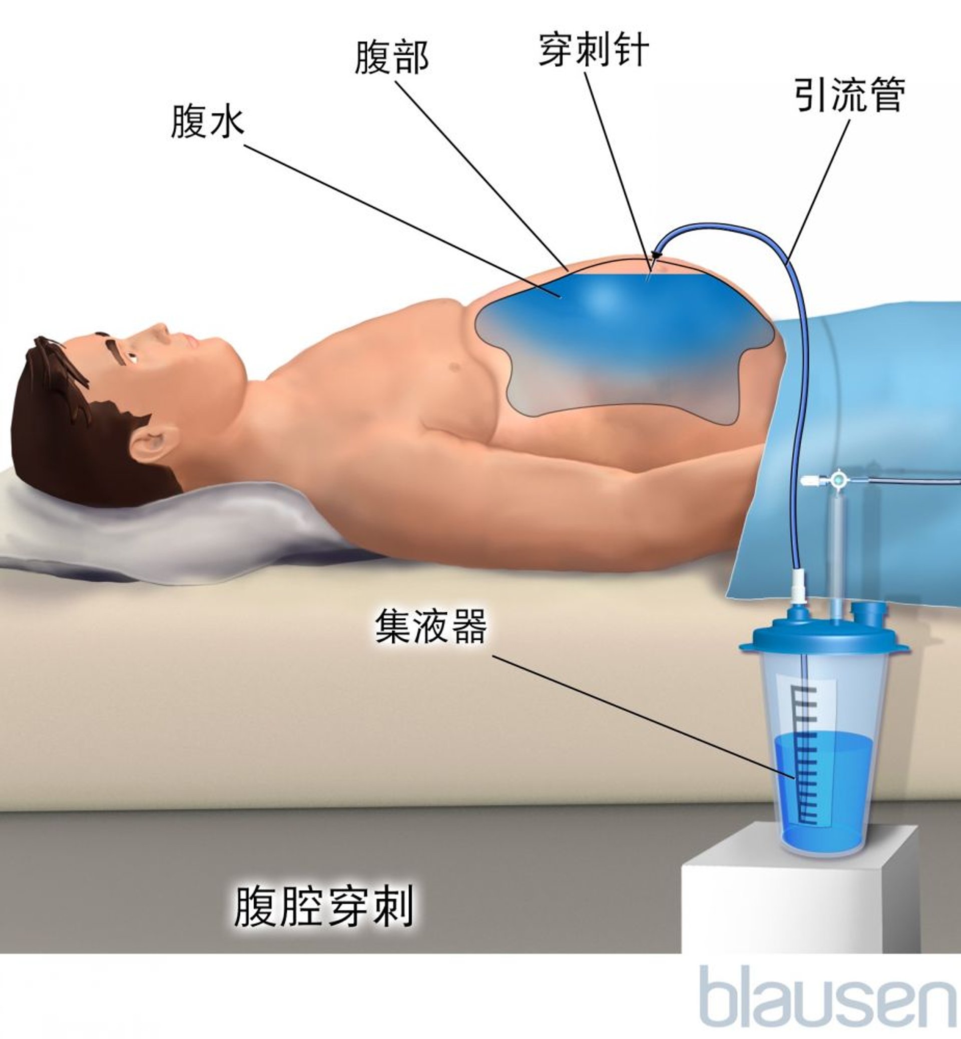 腹腔穿刺