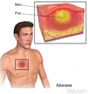 Skin Abscess