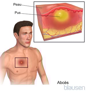 Abcès cutané