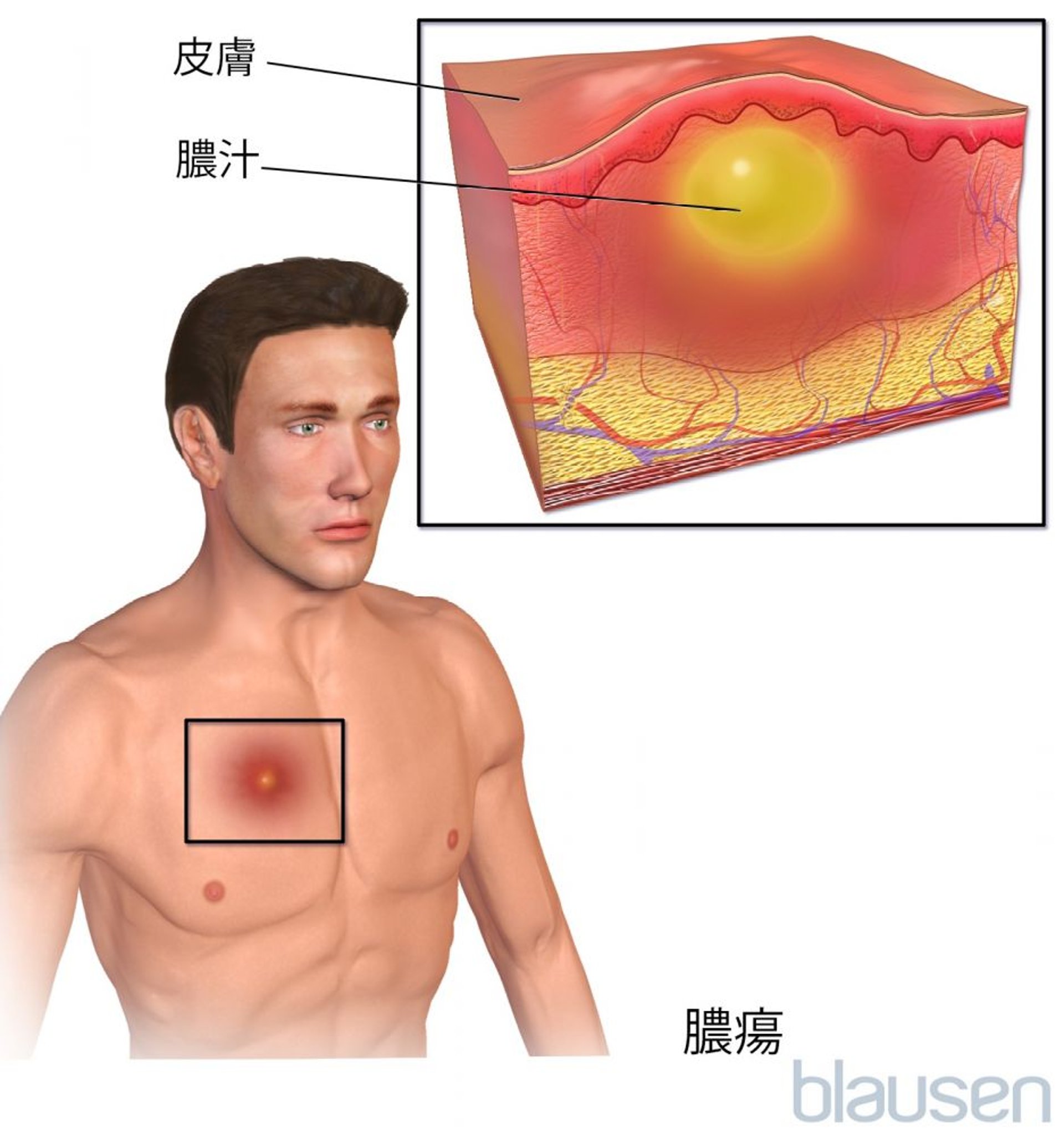 <ruby >皮膚膿瘍<rt >ひふのうよう</rt></ruby>