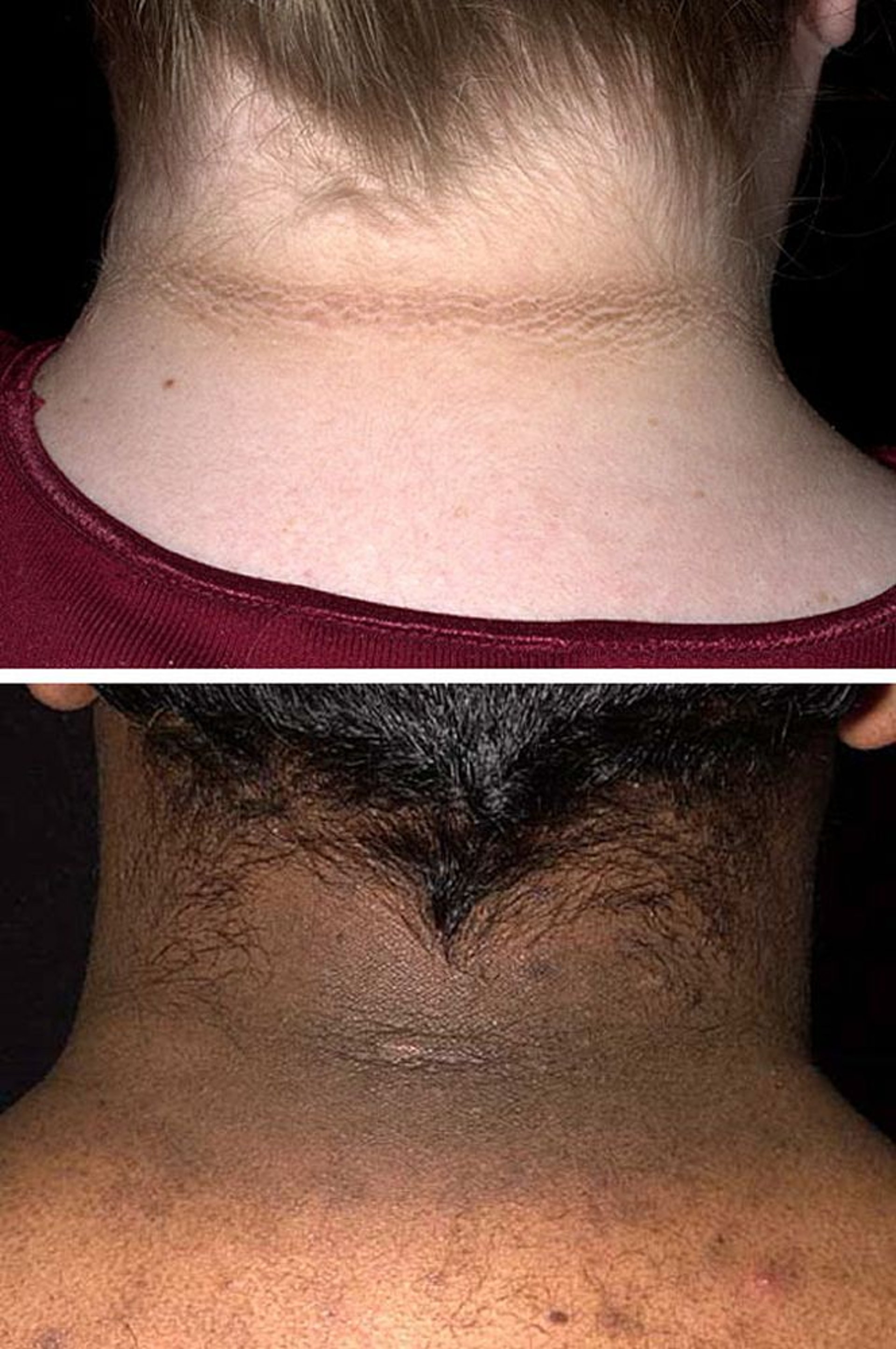 Acanthosis nigricans dans le syndrome des ovaires polykystiques