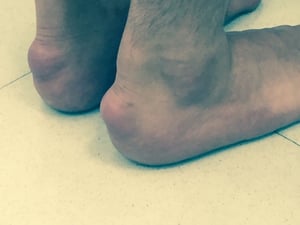 跟腱黄色瘤