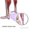Achilles Tendon Tear