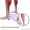 Déchirure du tendon d’Achille