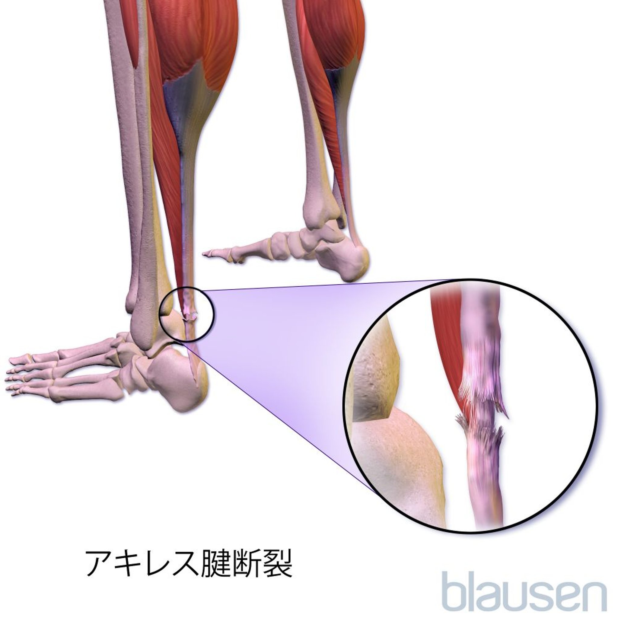 アキレス<ruby >腱<rt >けん</rt></ruby>の<ruby >断裂<rt >だんれつ</rt></ruby>