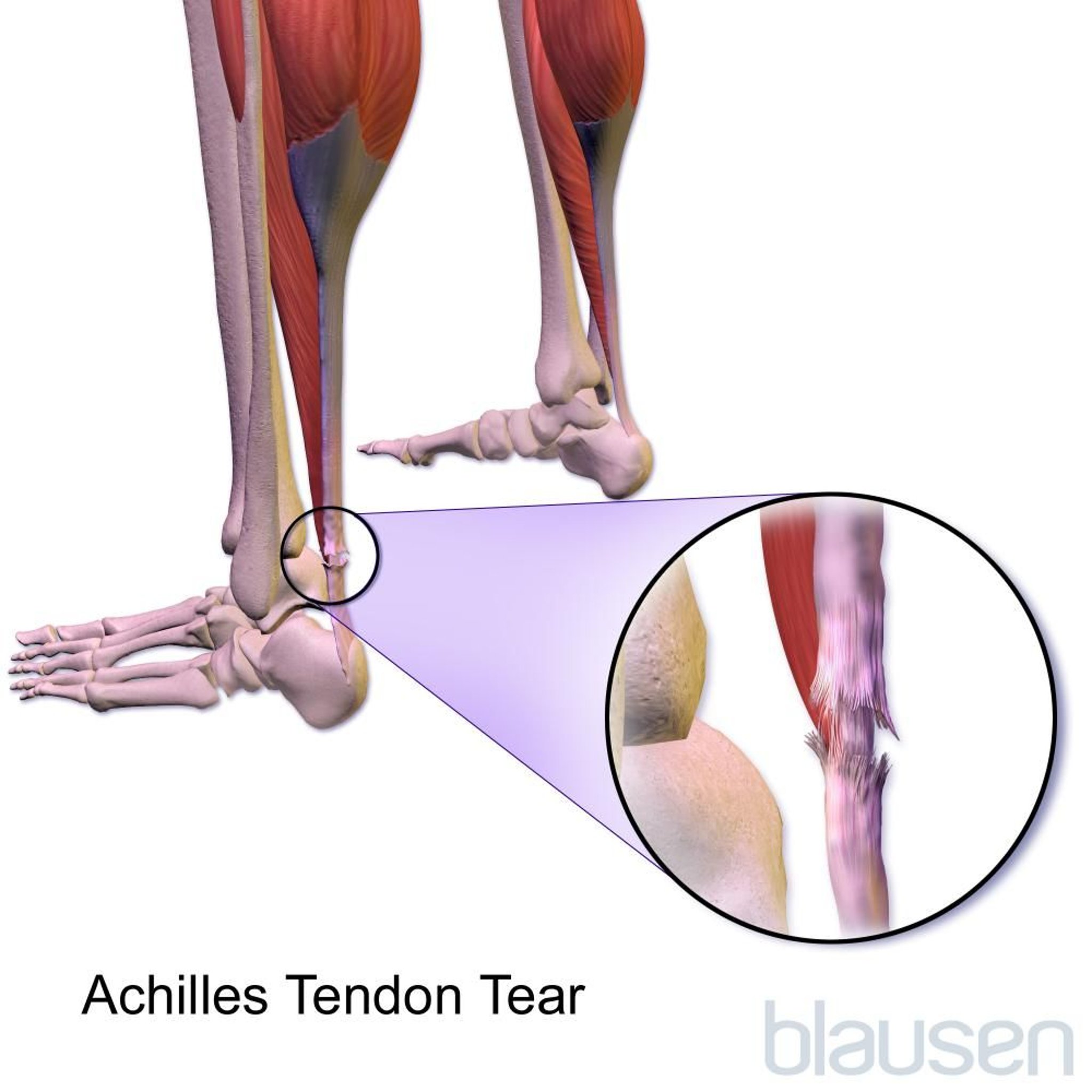아킬레스건 파열