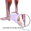 Laceração do tendão calcâneo