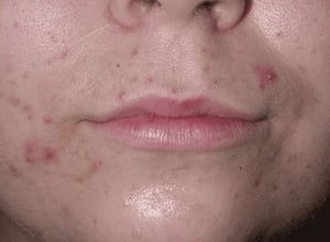 حب الشباب (العدّ)