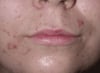 Acne