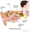 Vestibular Schwannoma (Acoustic Neuroma)
