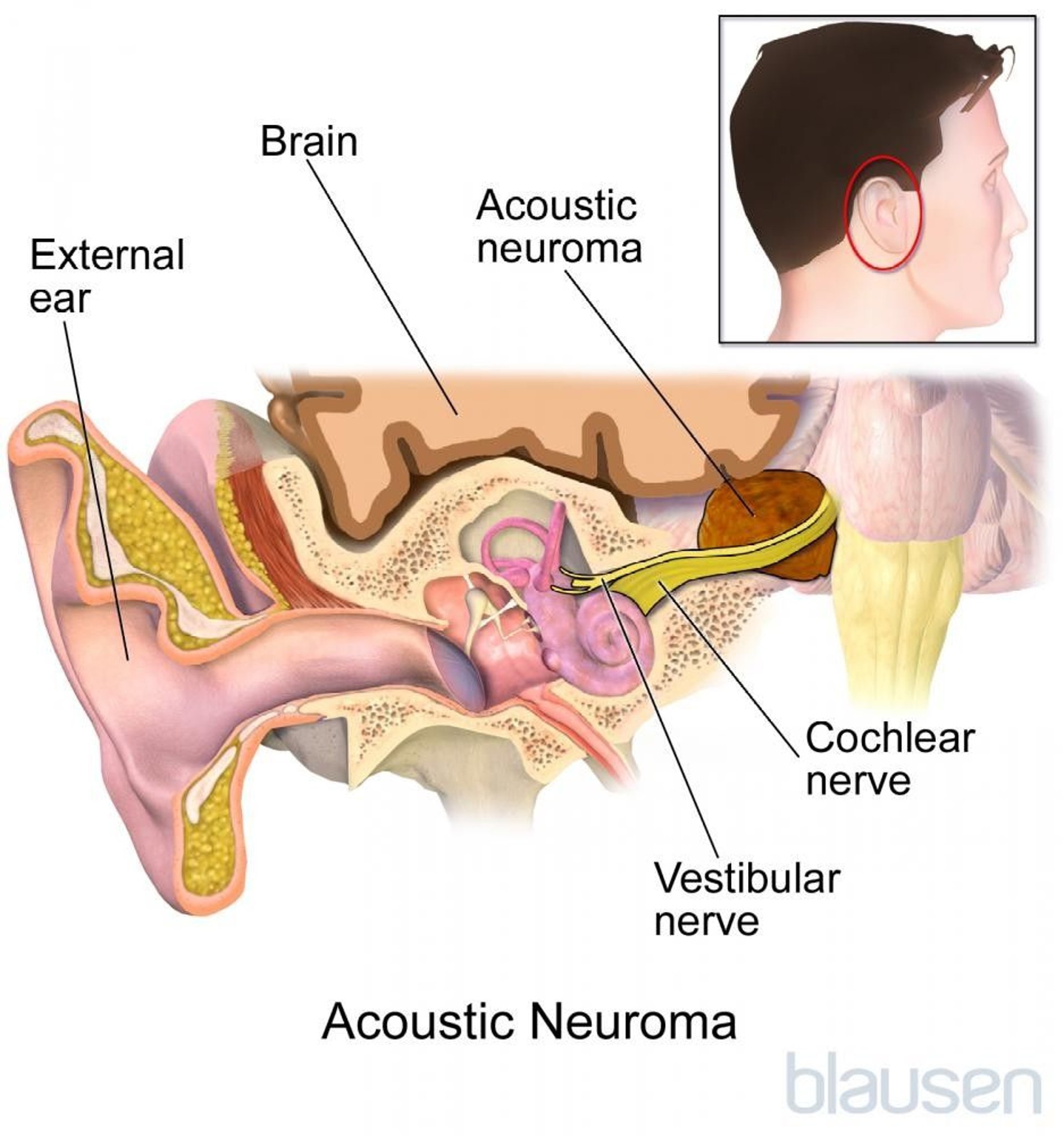 Vestibular Schwannoma (Acoustic Neuroma)