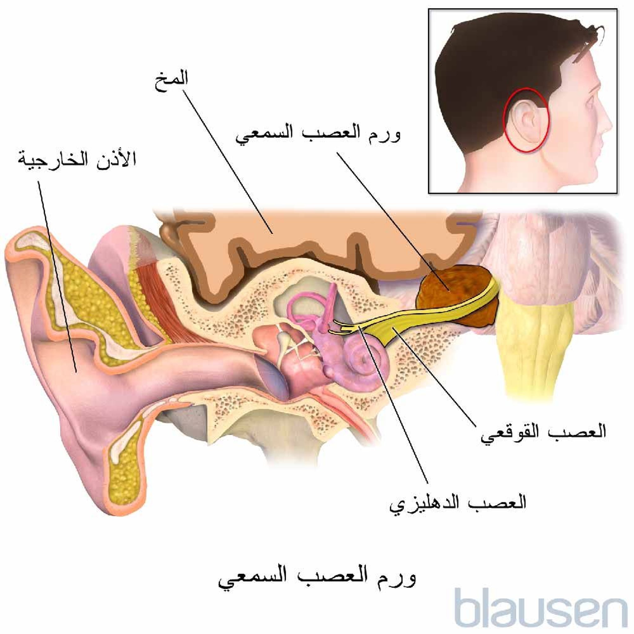 الورم الشفاني الدهليزي (ورم العصب السمعي)