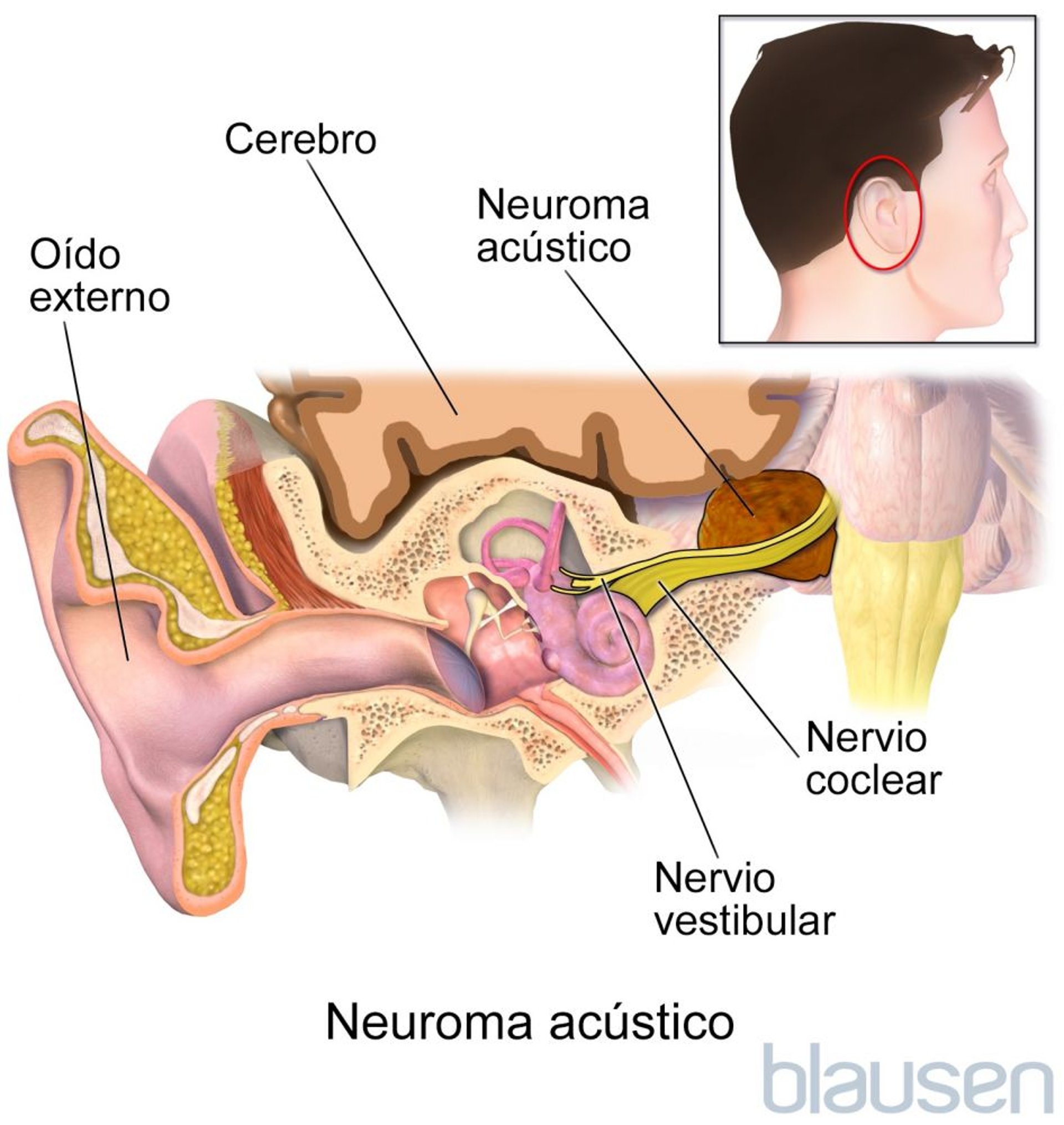 Schwannoma vestibular (neuroma acústico)