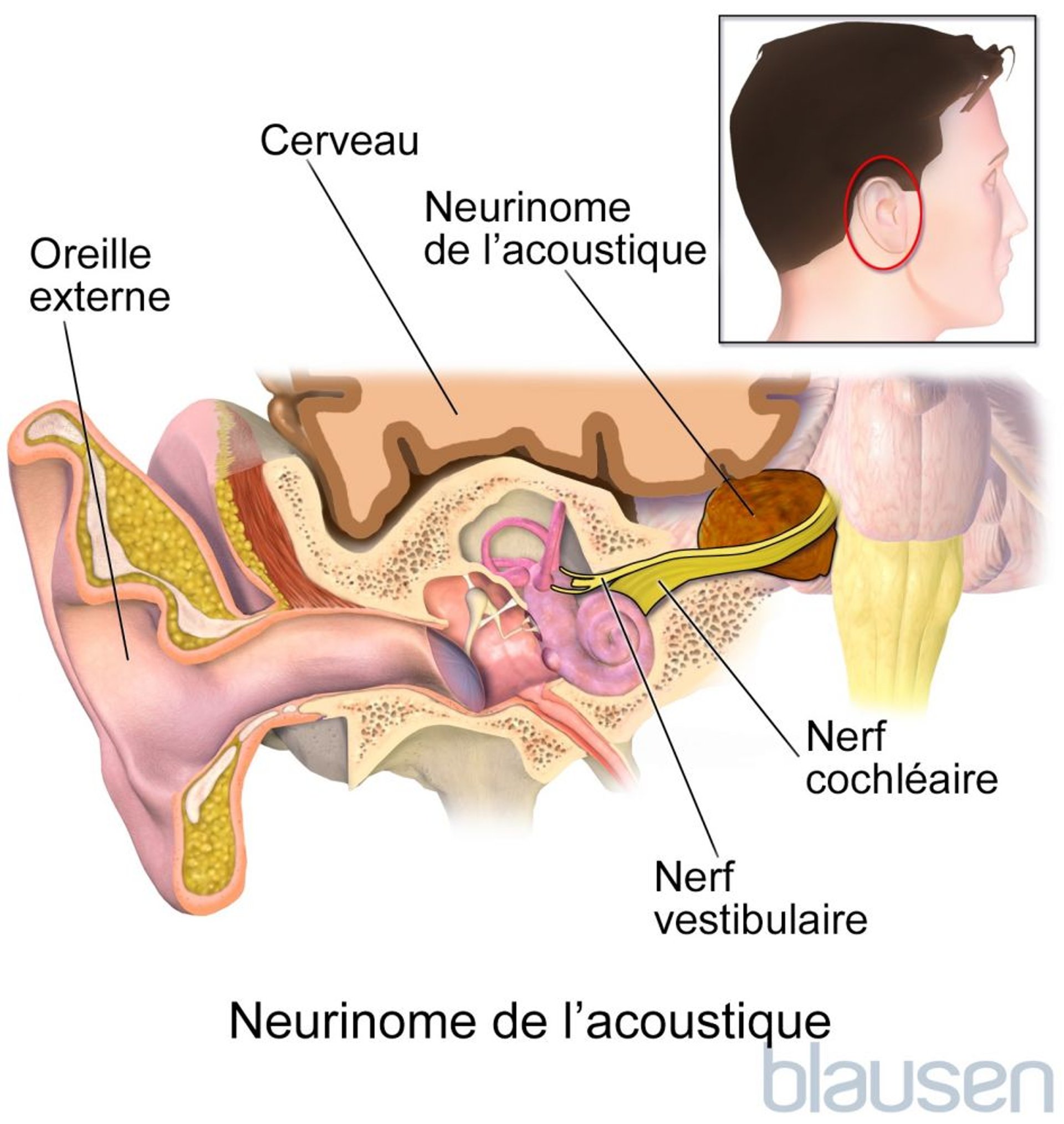 Schwannome vestibulaire (neurinome de l’acoustique)