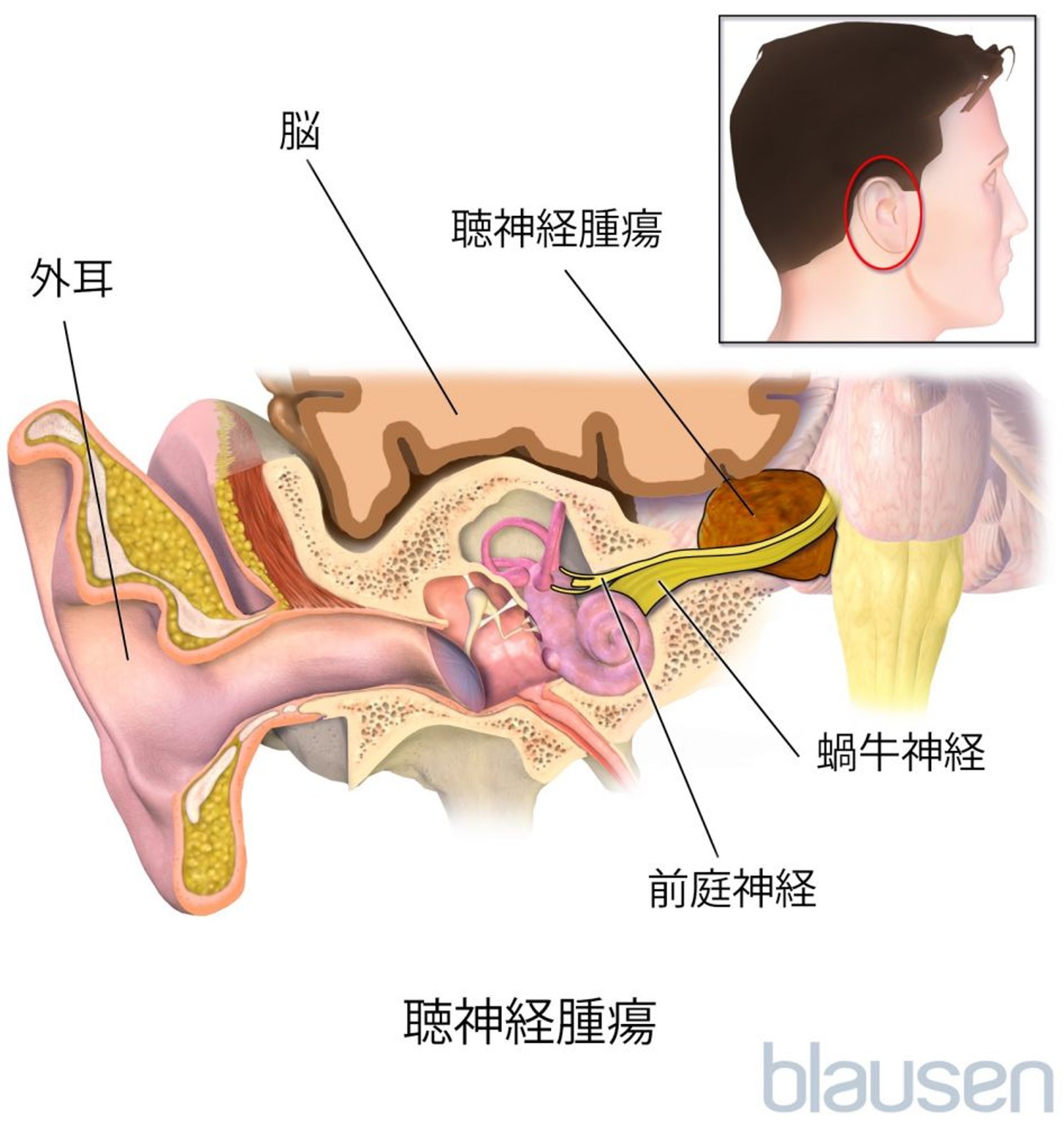 前庭神経鞘腫（聴神経腫瘍）