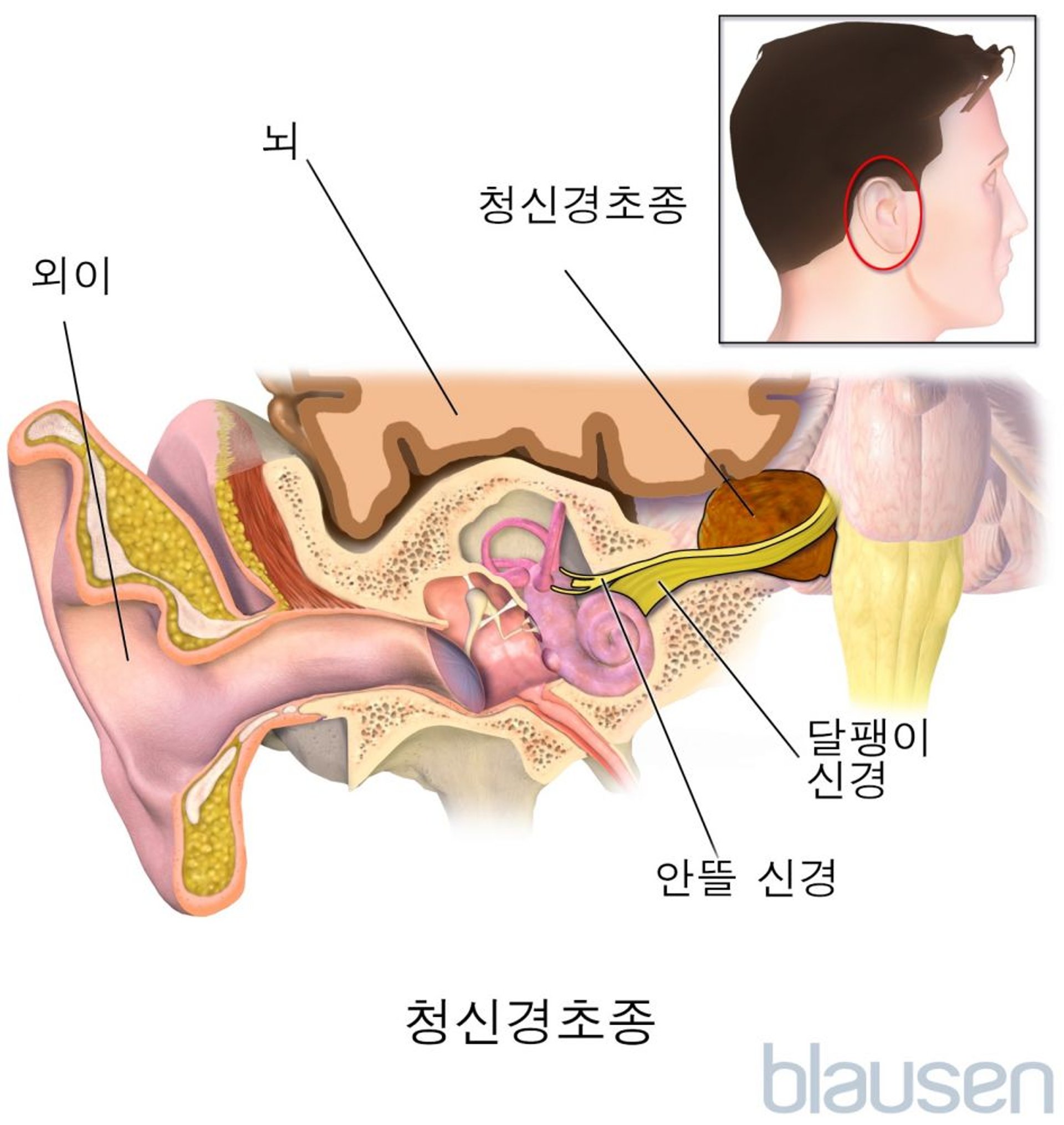 전정 신경집종(청신경종)