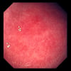 Akute Gastritis
