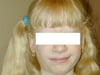 Albinism (Skin Symptoms)