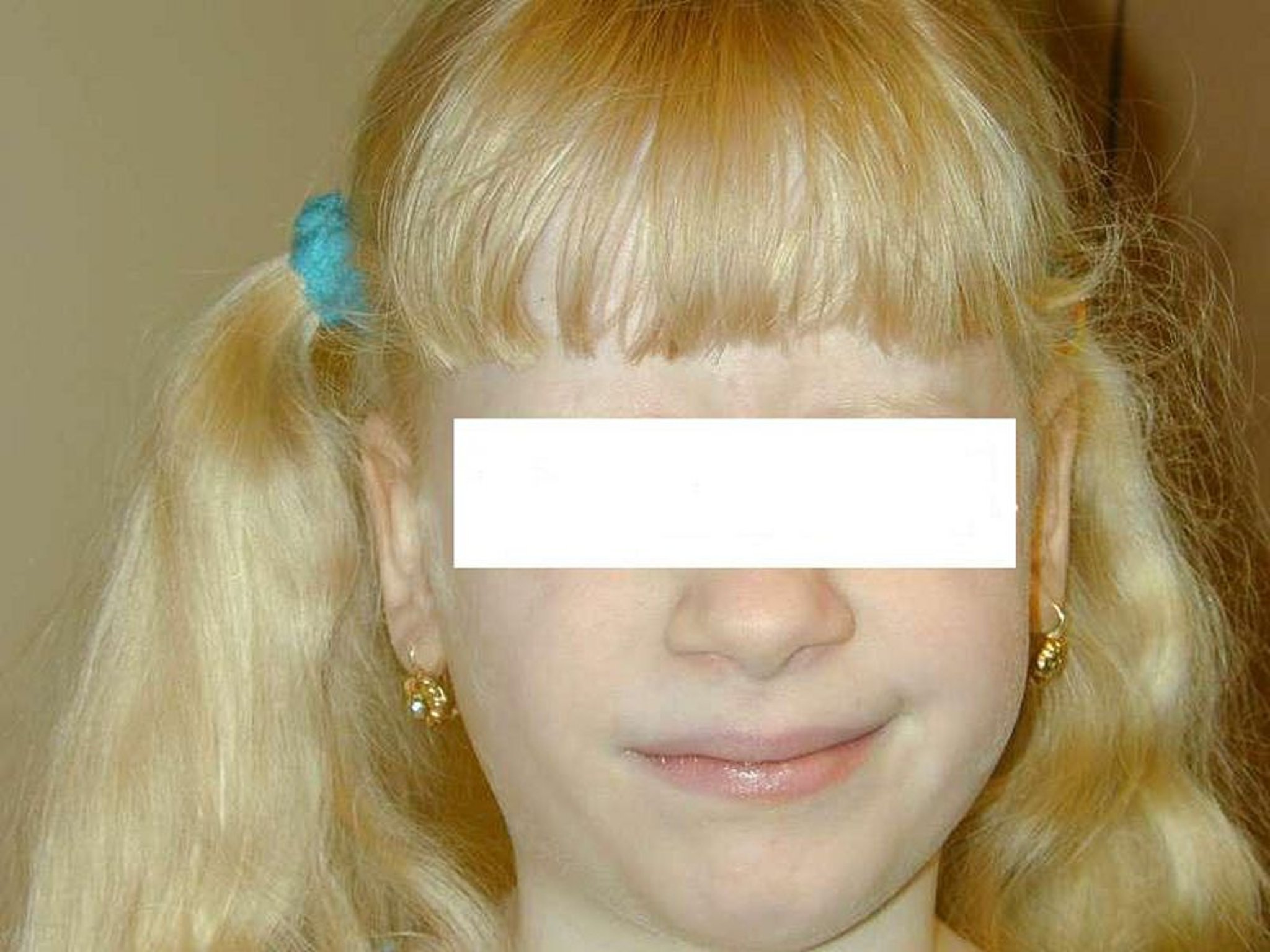 Albinisme (symptômes cutanés)