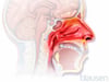Rhinite allergique