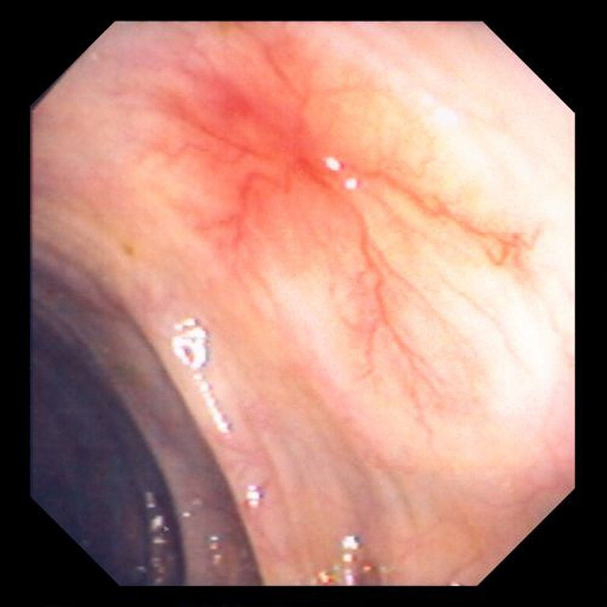 Abnormal Blood Vessels (Angiodysplasia) in the Intestine