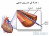 دعامة رأب الوعاء