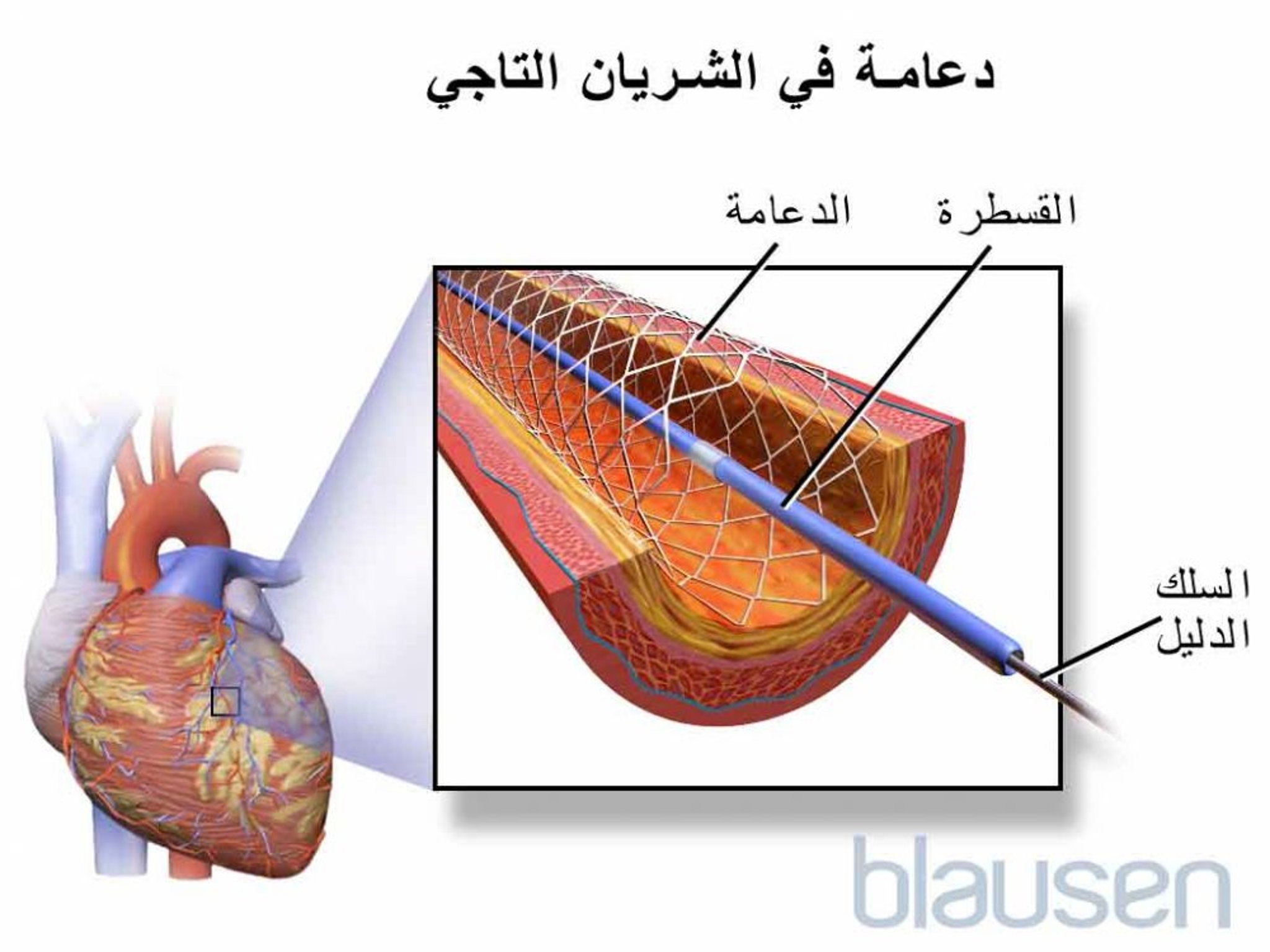 دعامة رأب الوعاء