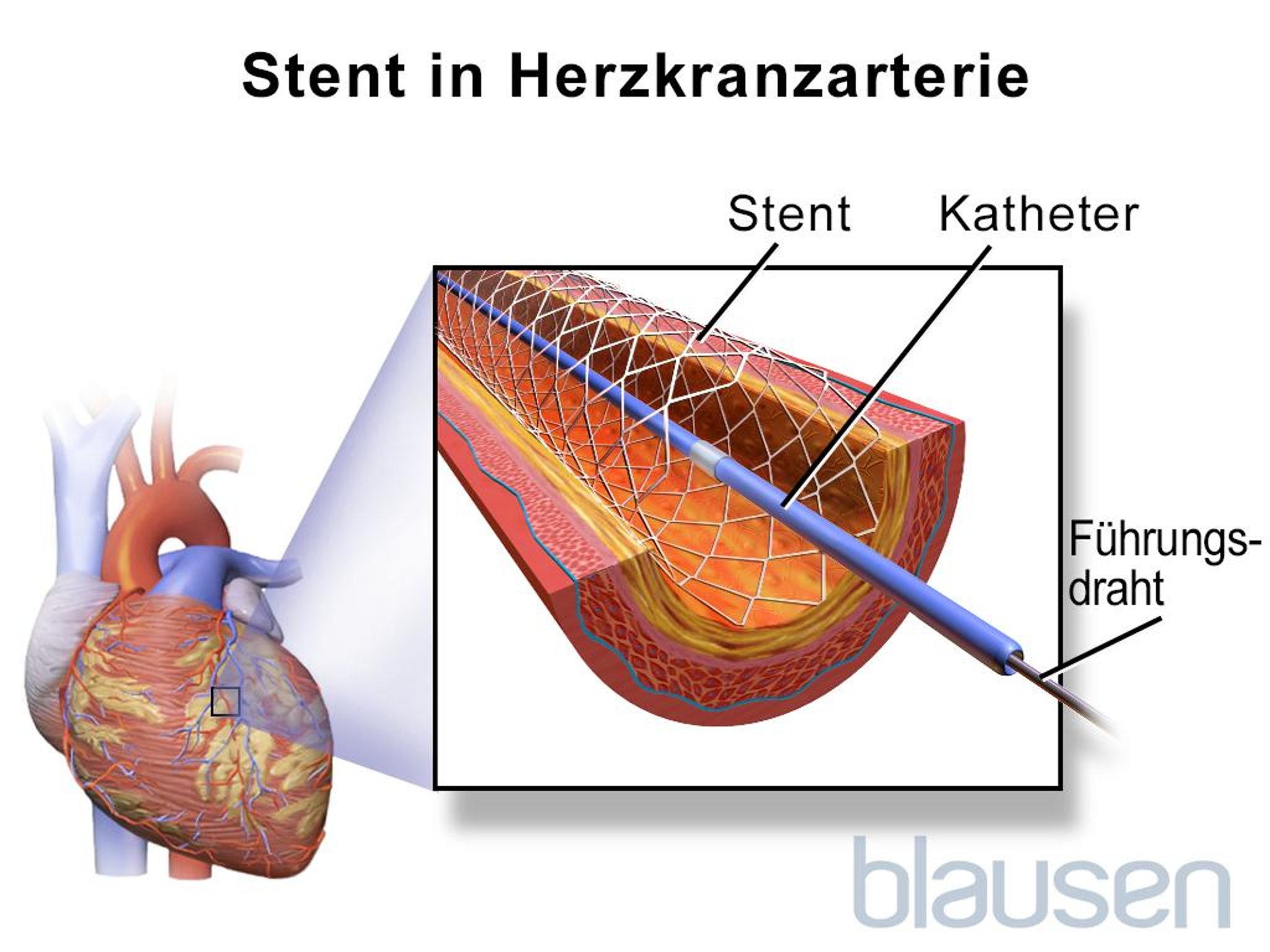 Angioplastie-Stent