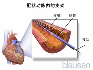 血管成形术支架