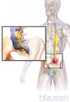 Espondilitis anquilosante