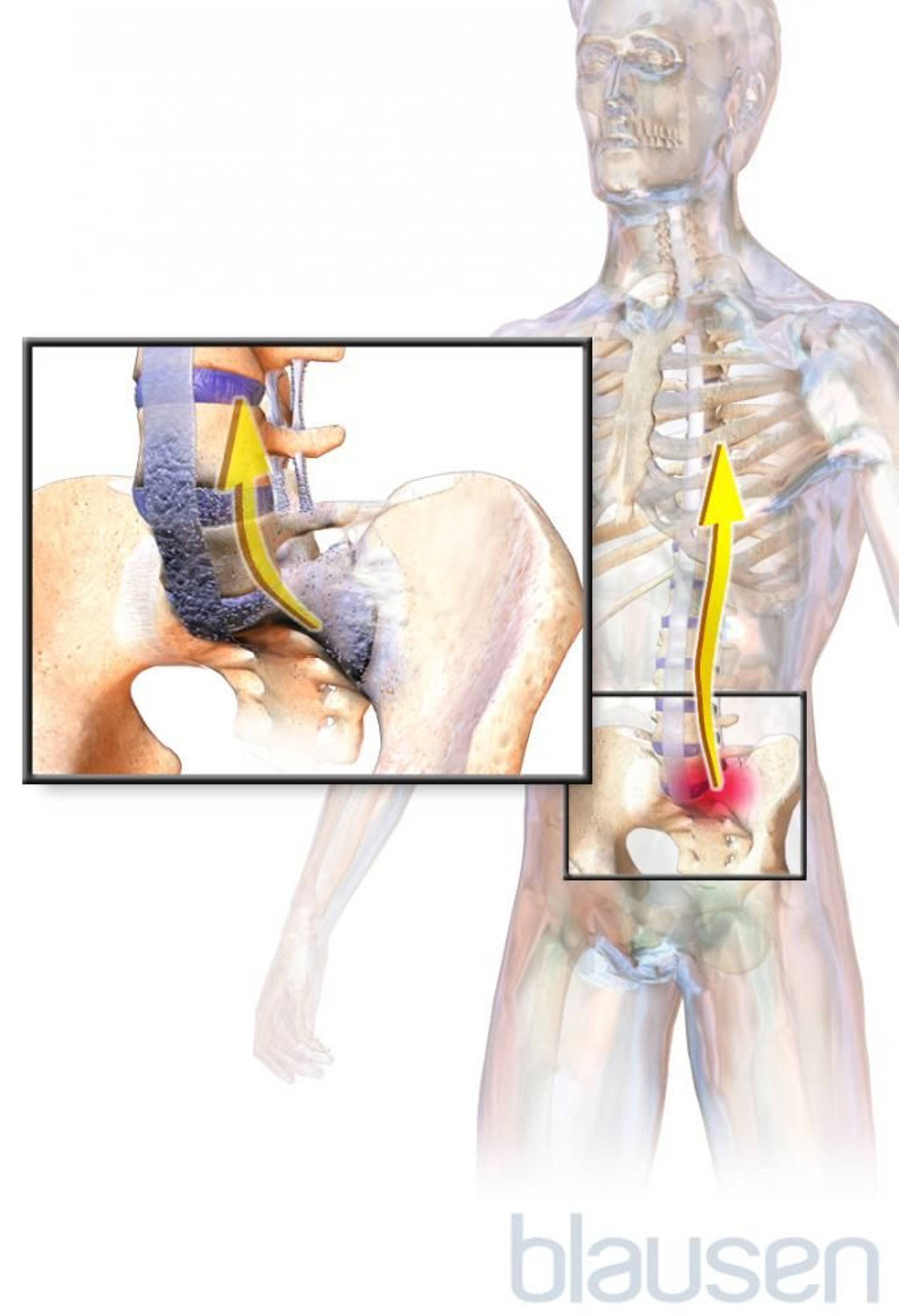 Espondilitis anquilosante