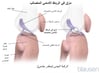 تمزق الرِّباط التَّصالُبِي الأَمامِي (ACL)