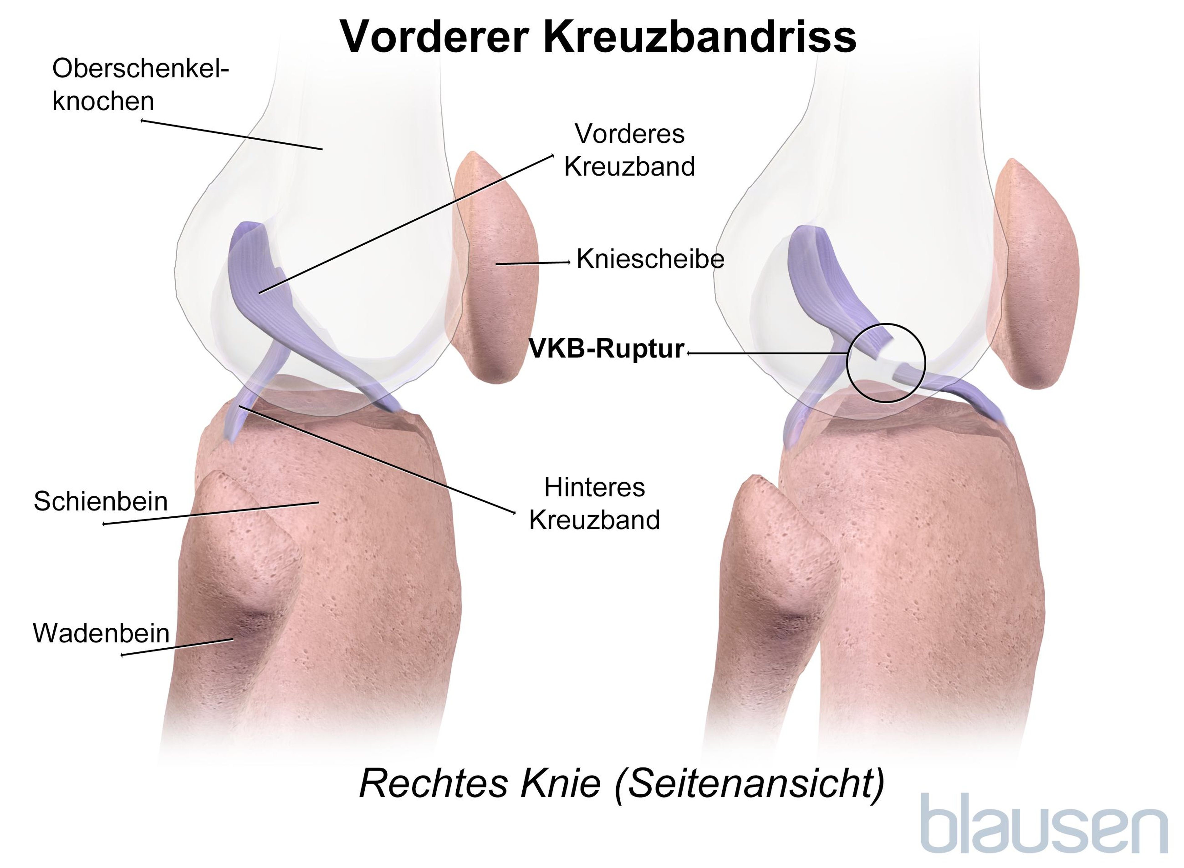 Vorderer Kreuzbandriss (VKB)