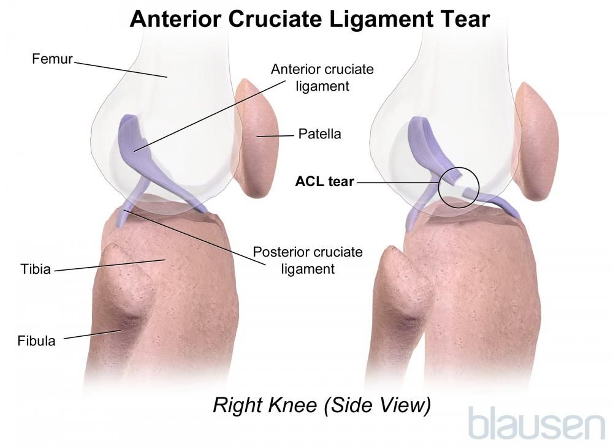 Déchirure du ligament croisé antérieur (LCA)