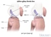 एंटीरियर क्रूसिएट लिगामेंट (ACL) टीयर
