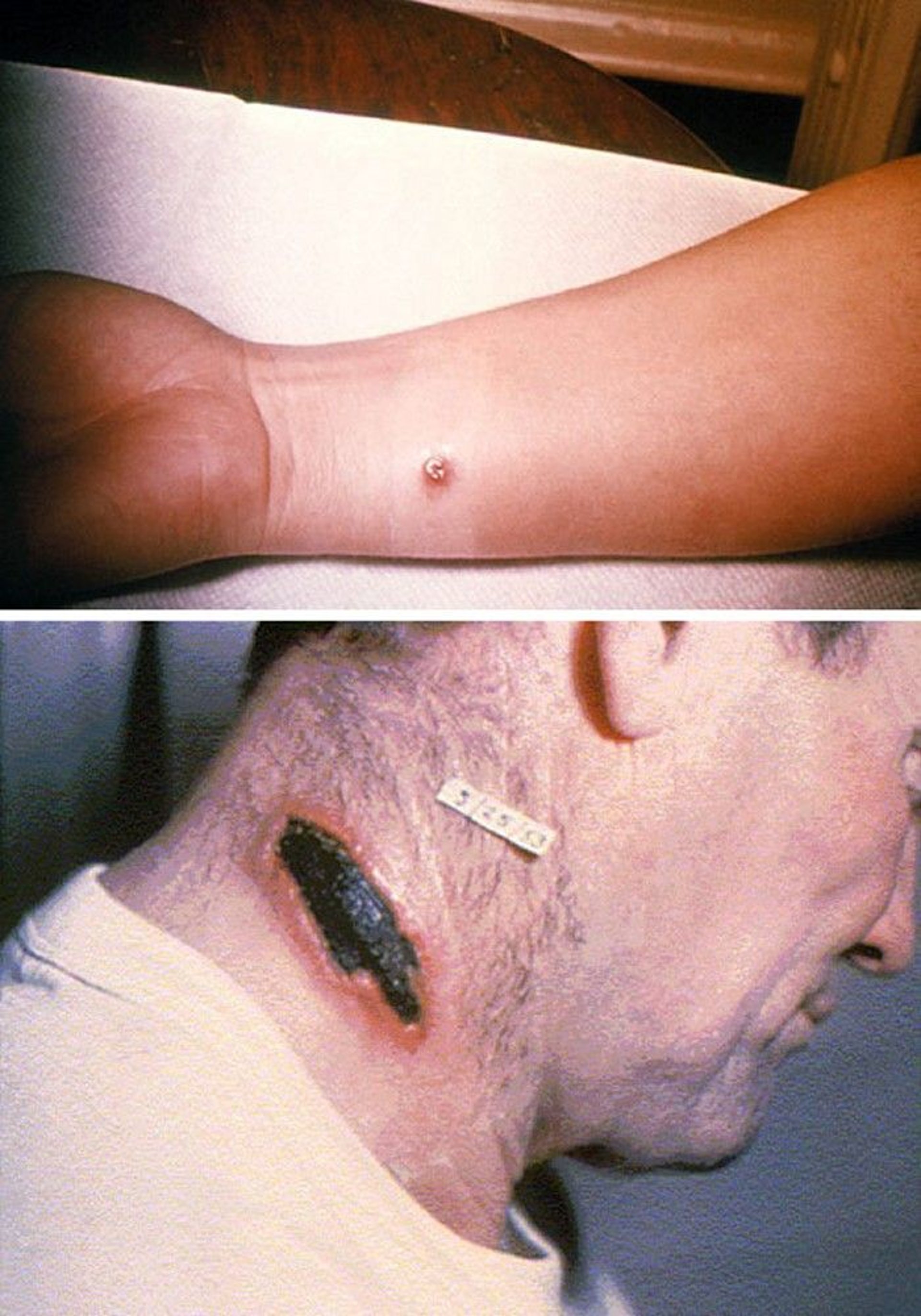 Skin Anthrax (Cutaneous Anthrax)