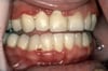 Gingivitis ulcerativa necrotizante aguda