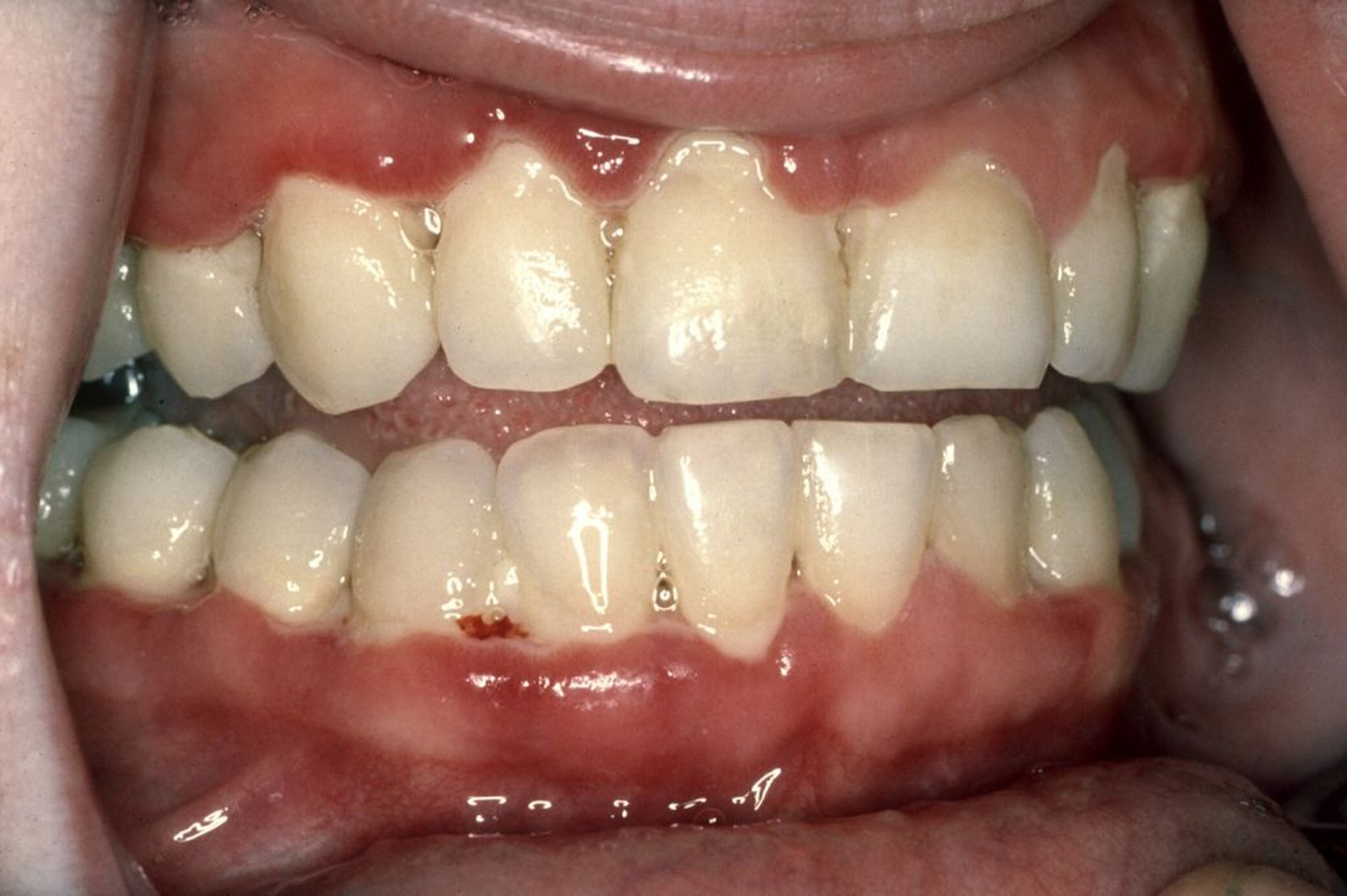 Gingivitis ulcerativa necrotizante aguda