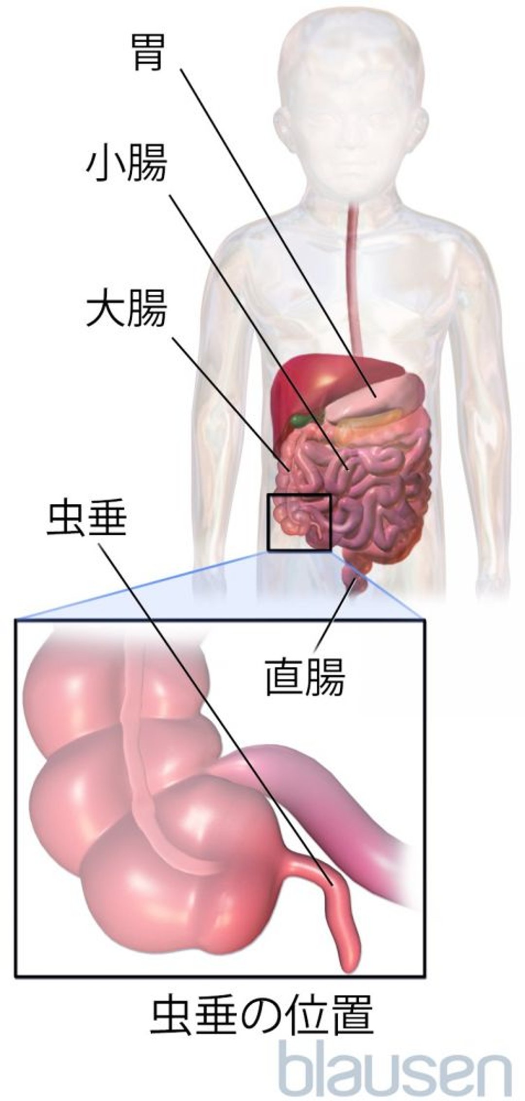 <ruby >虫垂<rt >ちゅうすい</rt></ruby>の<ruby >位置<rt >いち</rt></ruby>