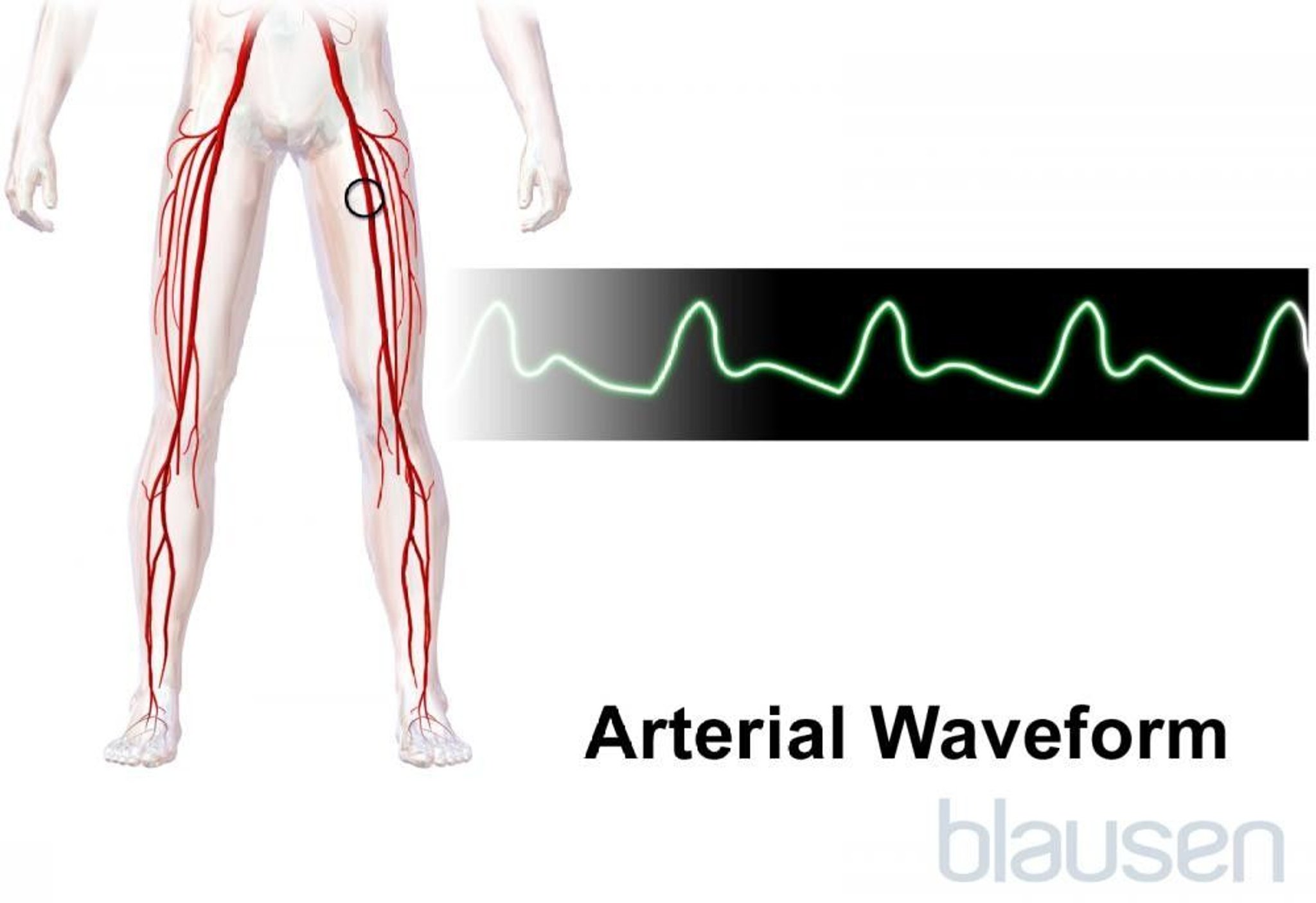 Arterial Waveform